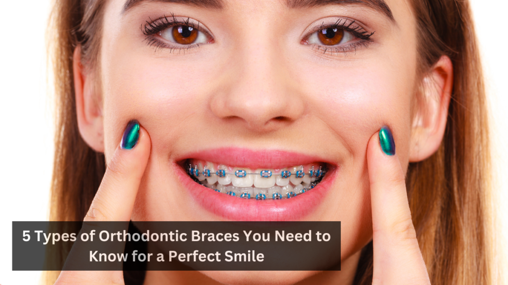 5 Types of Orthodontic Braces You Need to Know for a Perfect Smile